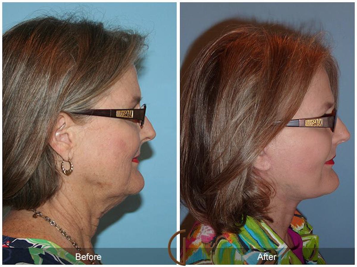 Facelift 60s Before & After Gallery - Patient 250379 - Image 3