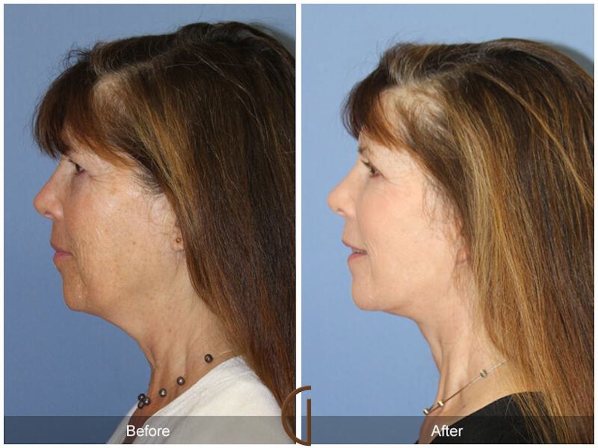 Facelift 60s Before & After Gallery - Patient 368646 - Image 1