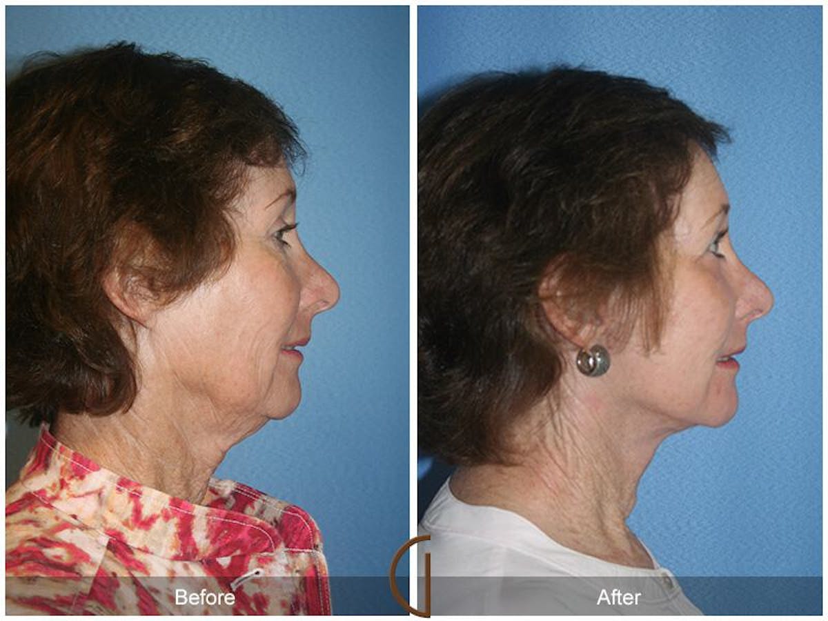 Facelift 60s Before & After Gallery - Patient 260156 - Image 3