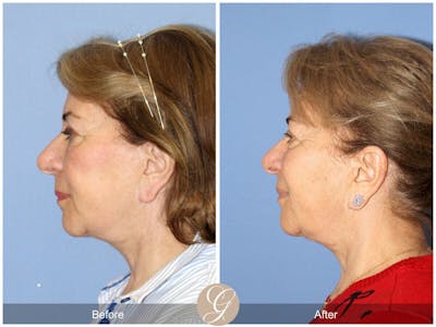 Facelift 60s Before & After Gallery - Patient 326744 - Image 1