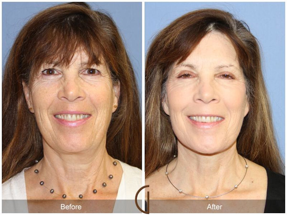 Facelift 60s Before & After Gallery - Patient 368646 - Image 2