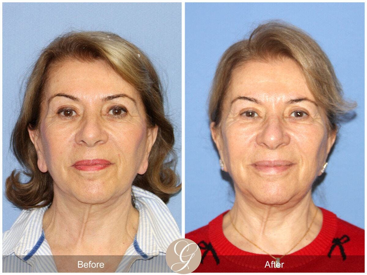 Facelift 60s Before & After Gallery - Patient 326744 - Image 2