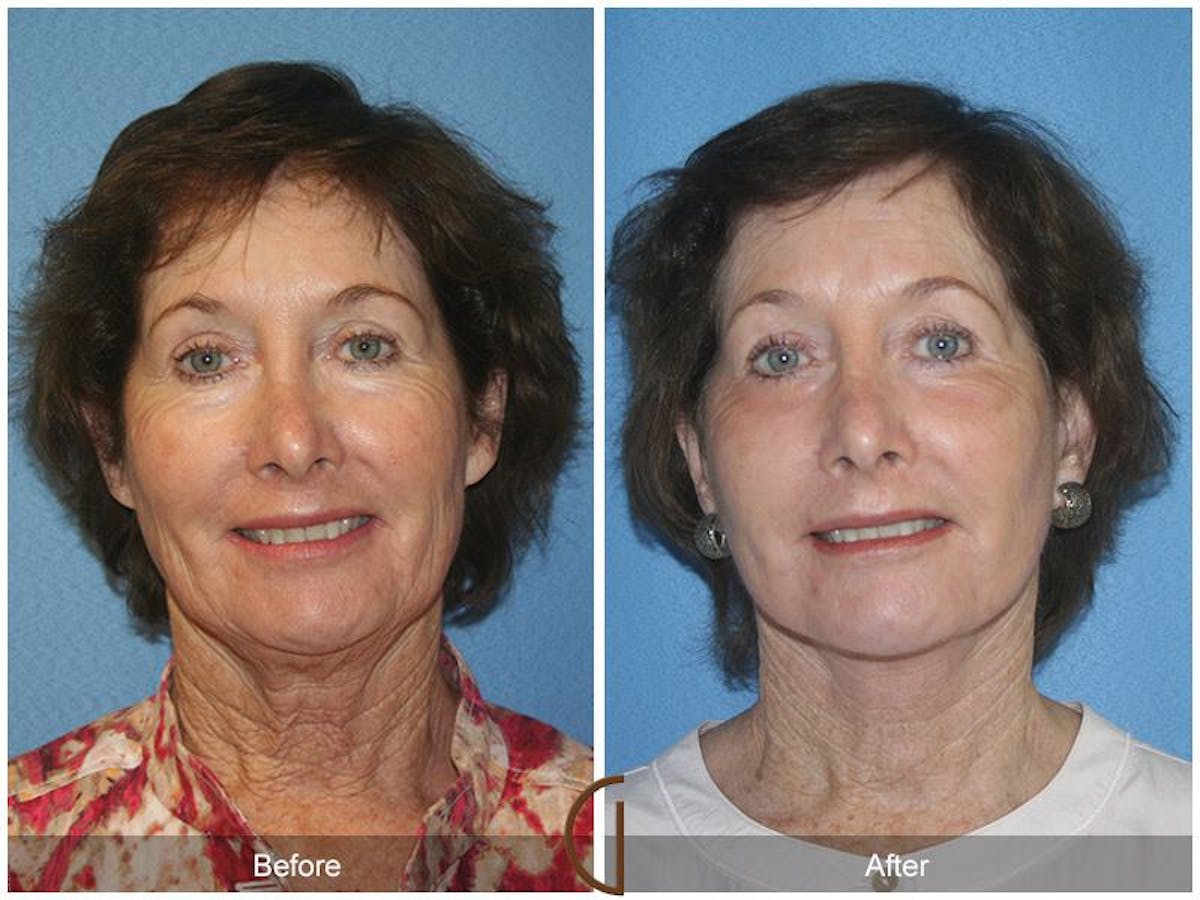 Facelift 60s Before & After Gallery - Patient 260156 - Image 2