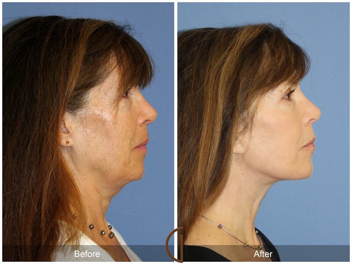 Facelift 60s Before & After Gallery - Patient 368646 - Image 3
