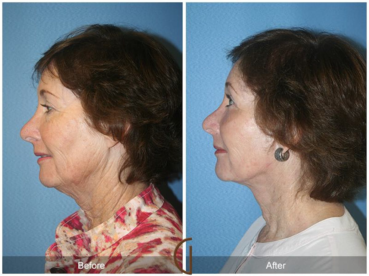 Facelift 60s Before & After Gallery - Patient 260156 - Image 1