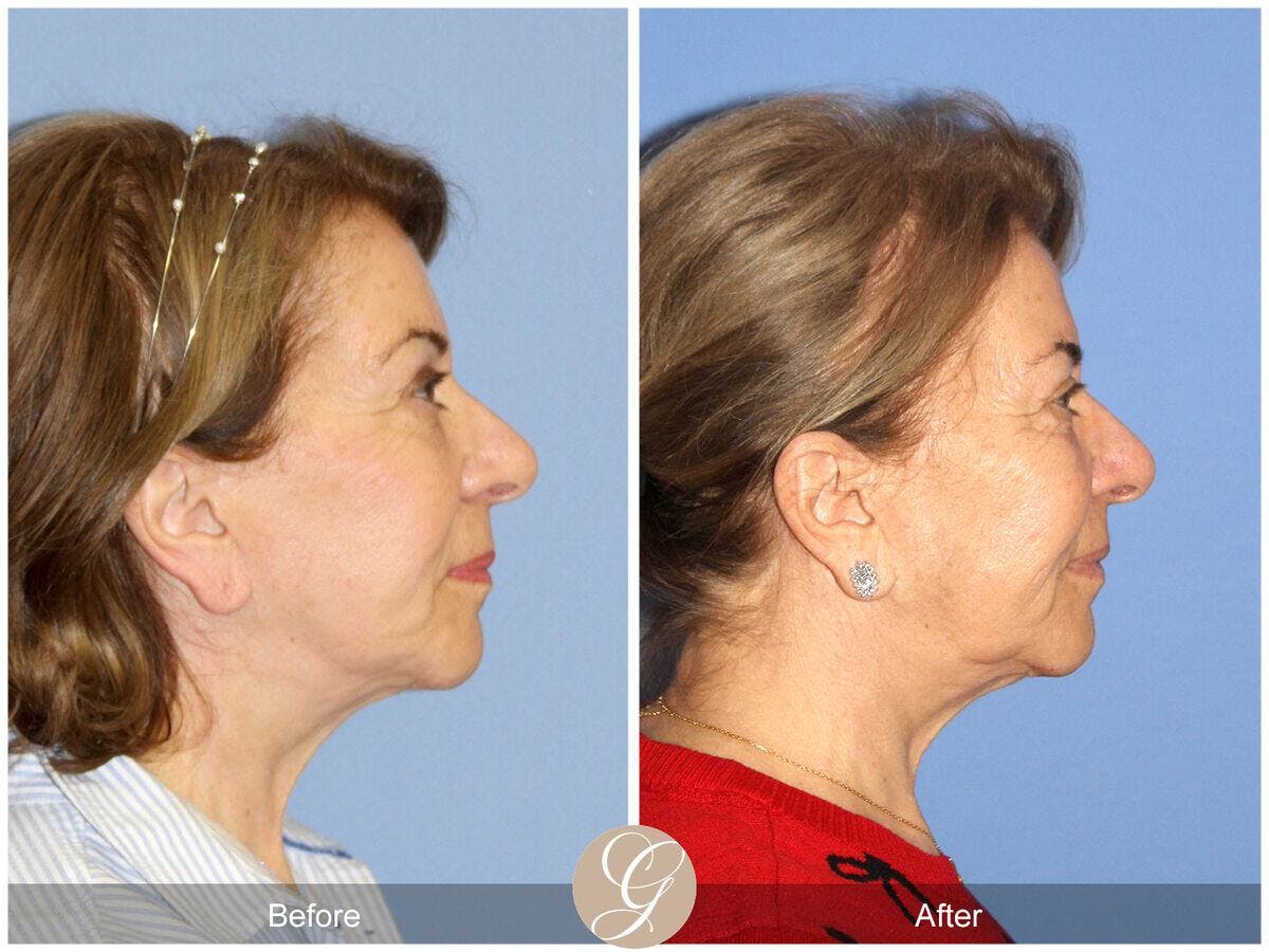 Facelift 60s Before & After Gallery - Patient 326744 - Image 3