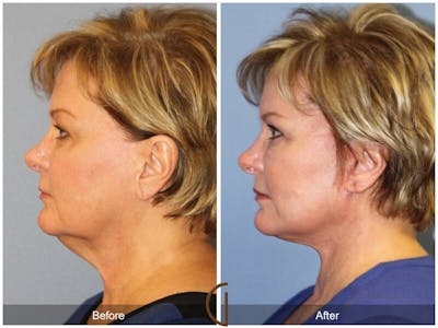 Facelift 60s Before & After Gallery - Patient 187755 - Image 1