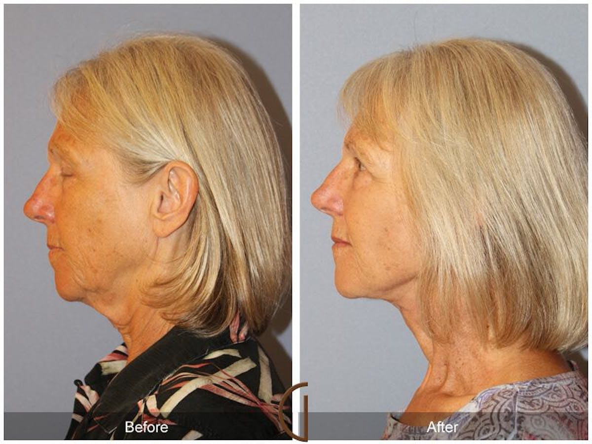 Facelift 60s Before & After Gallery - Patient 345927 - Image 1