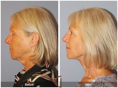 Facelift 60s Before & After Gallery - Patient 345927 - Image 1