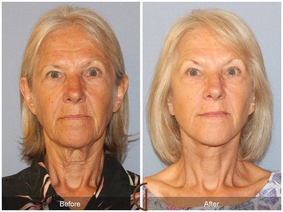 Facelift 60s Before & After Gallery - Patient 345927 - Image 2