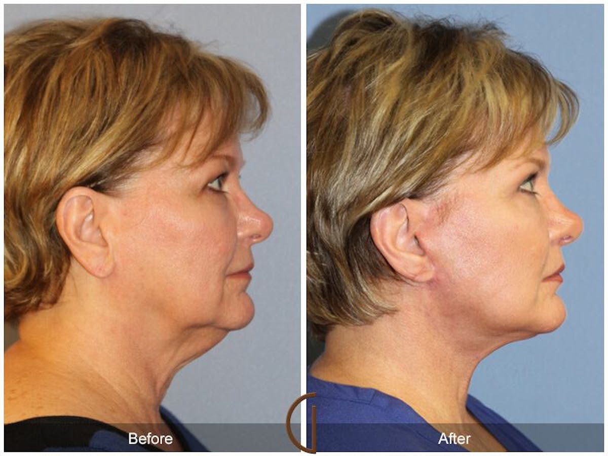 Facelift 60s Before & After Gallery - Patient 187755 - Image 3