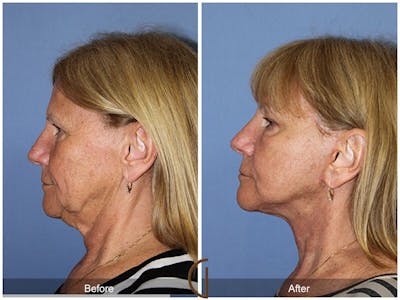 Facelift 60s Before & After Gallery - Patient 221585 - Image 1