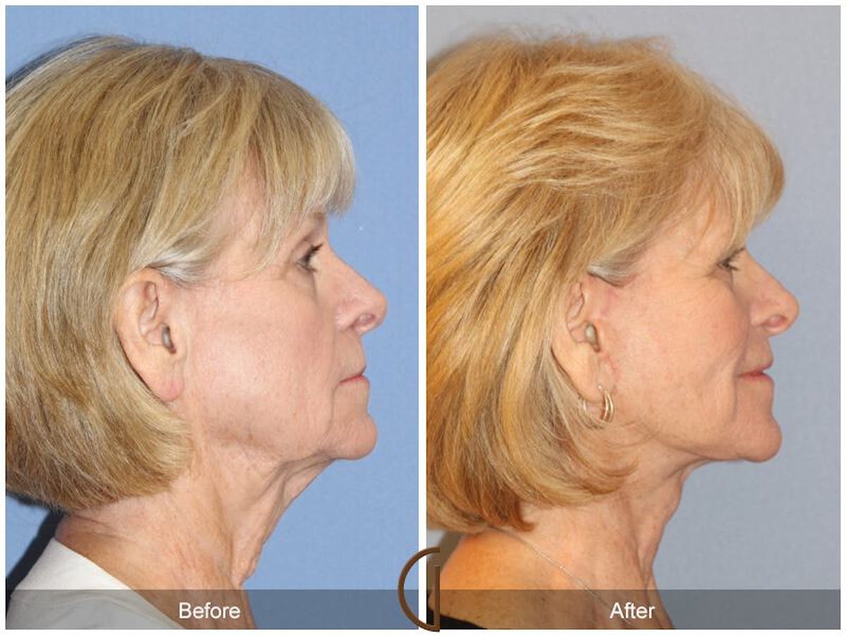Facelift 60s Before & After Gallery - Patient 463304 - Image 3