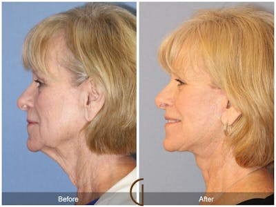 Facelift 60s Before & After Gallery - Patient 463304 - Image 1