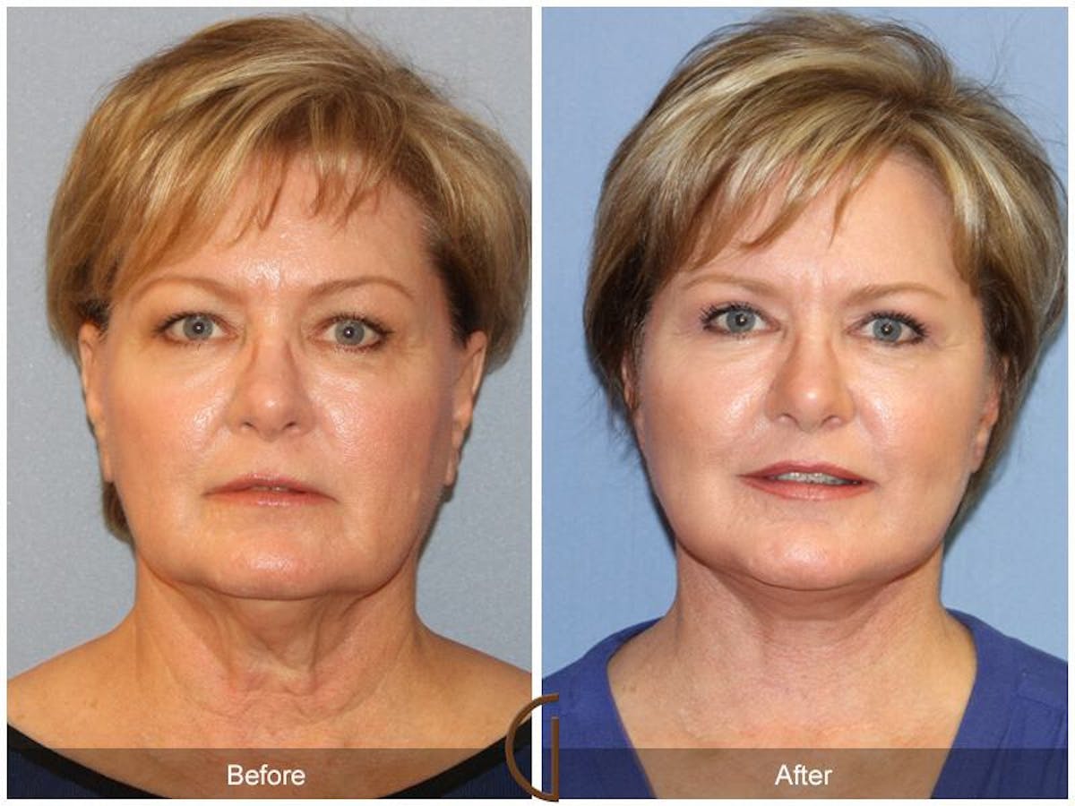 Facelift 60s Before & After Gallery - Patient 187755 - Image 2