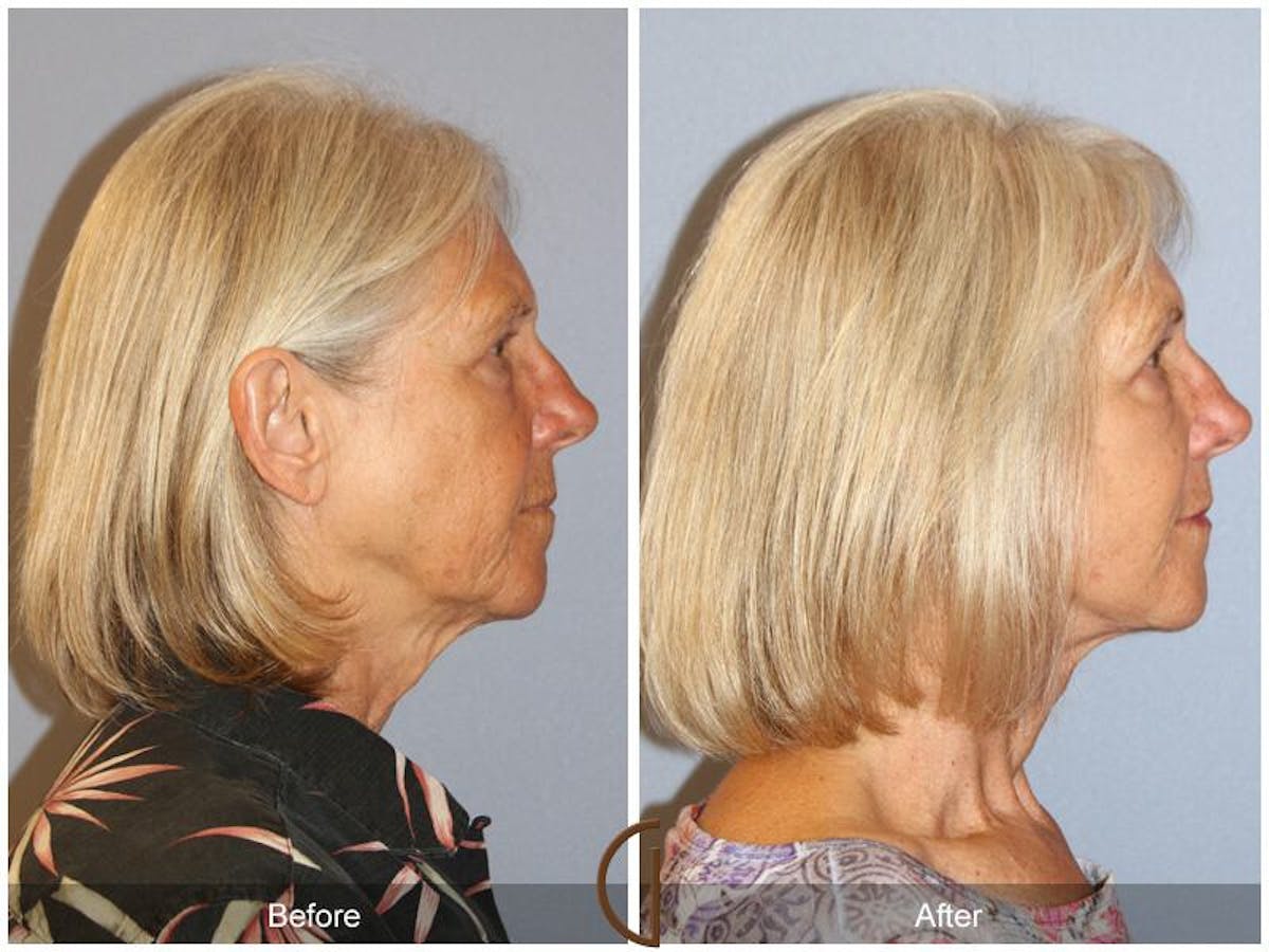 Facelift 60s Before & After Gallery - Patient 345927 - Image 3