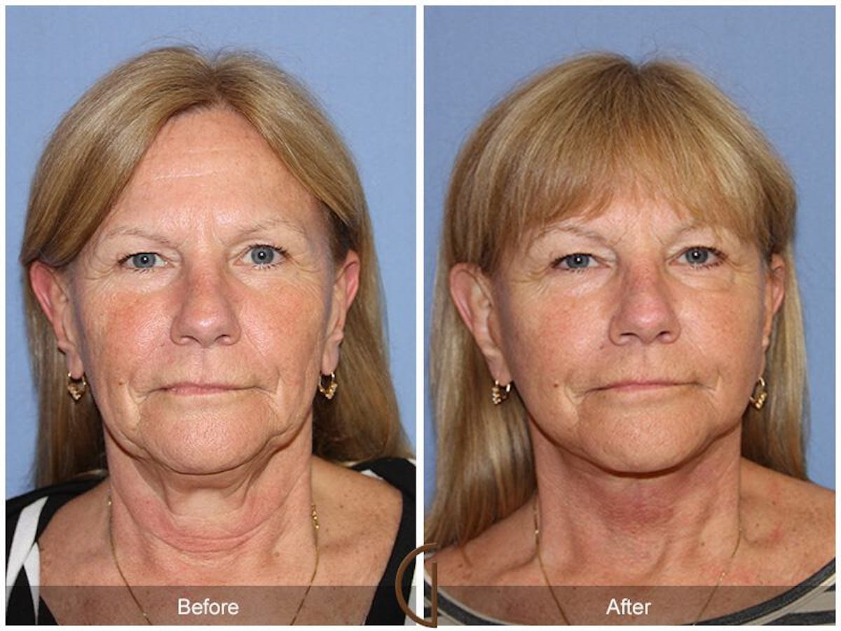 Facelift 60s Before & After Gallery - Patient 221585 - Image 2