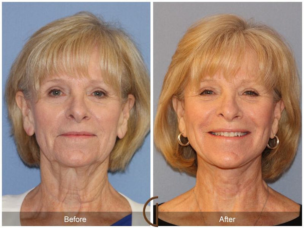Facelift 60s Before & After Gallery - Patient 463304 - Image 2