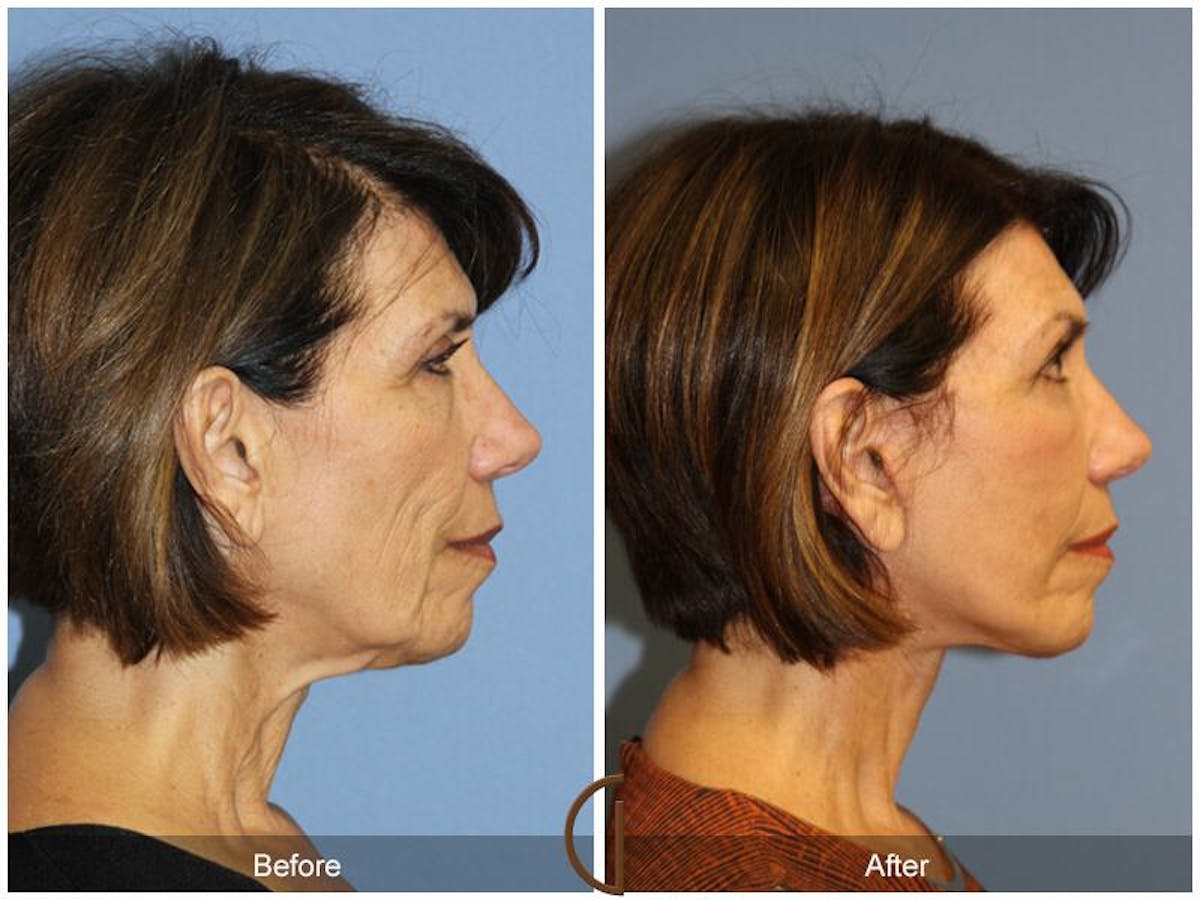 Facelift 60s Before & After Gallery - Patient 380801 - Image 3