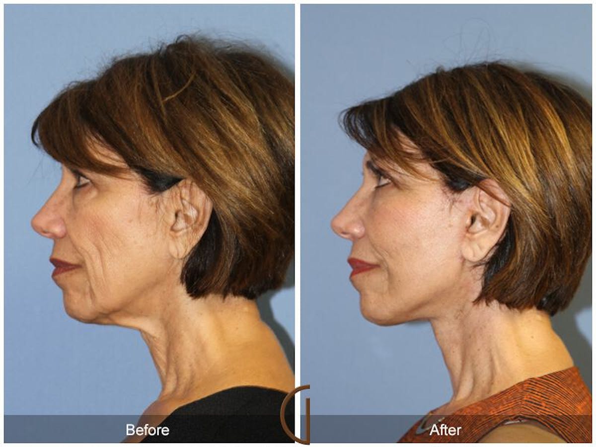 Facelift 60s Before & After Gallery - Patient 380801 - Image 1