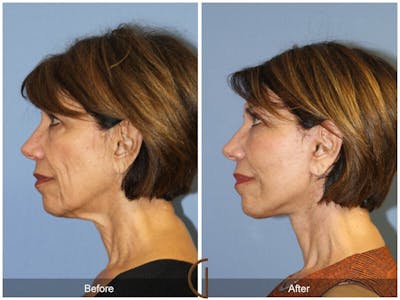 Facelift 60s Before & After Gallery - Patient 380801 - Image 1