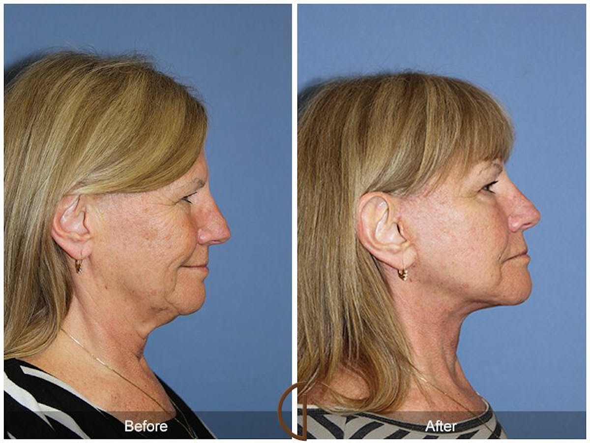 Facelift 60s Before & After Gallery - Patient 221585 - Image 3