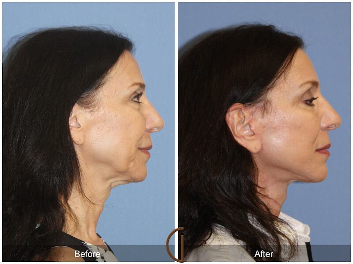 Facelift 60s Before & After Gallery - Patient 324070 - Image 3