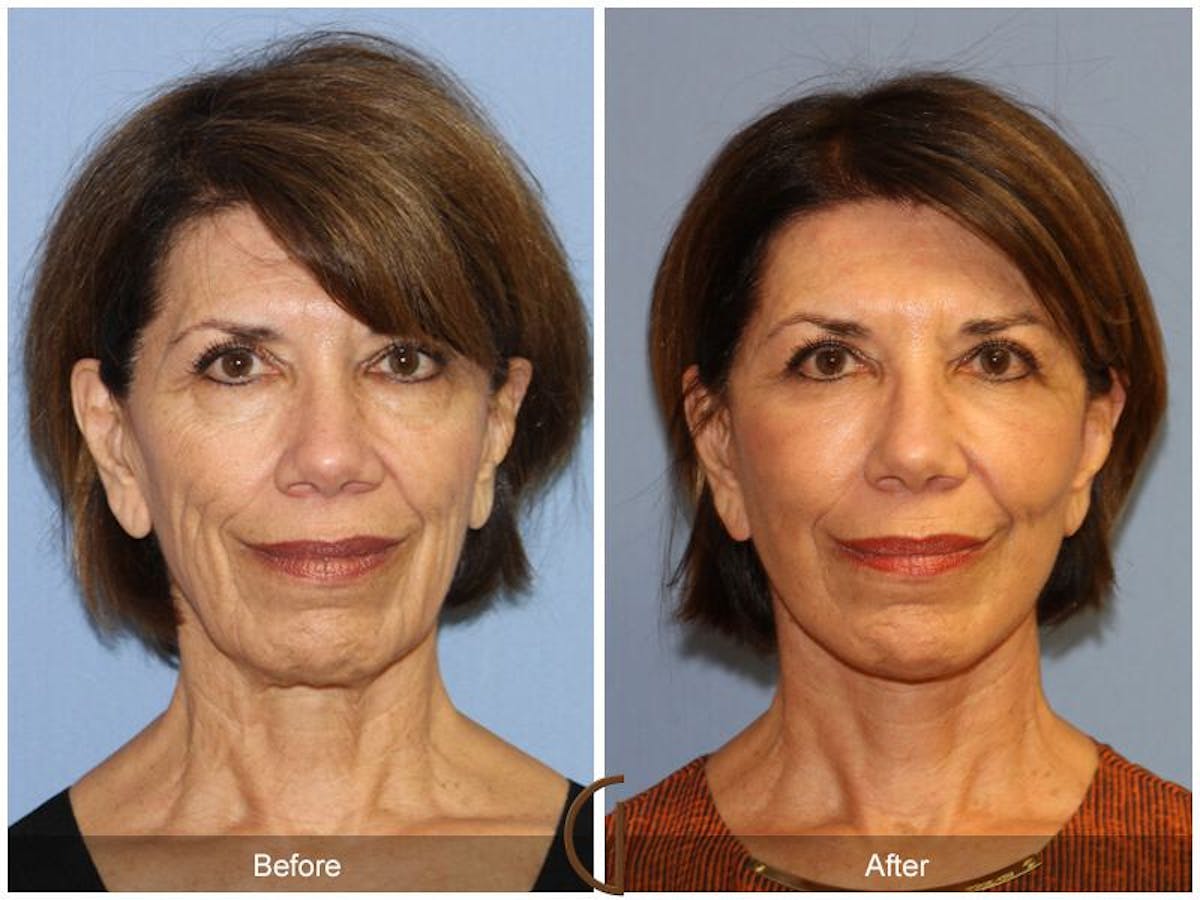 Facelift 60s Before & After Gallery - Patient 380801 - Image 2