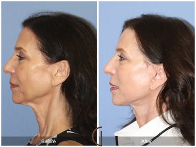Facelift 60s Before & After Gallery - Patient 324070 - Image 1
