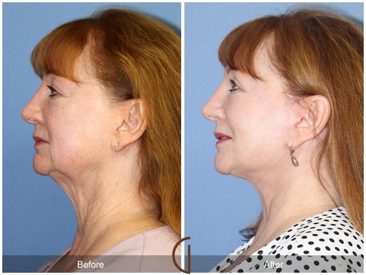 Facelift 60s Before & After Gallery - Patient 381577 - Image 1