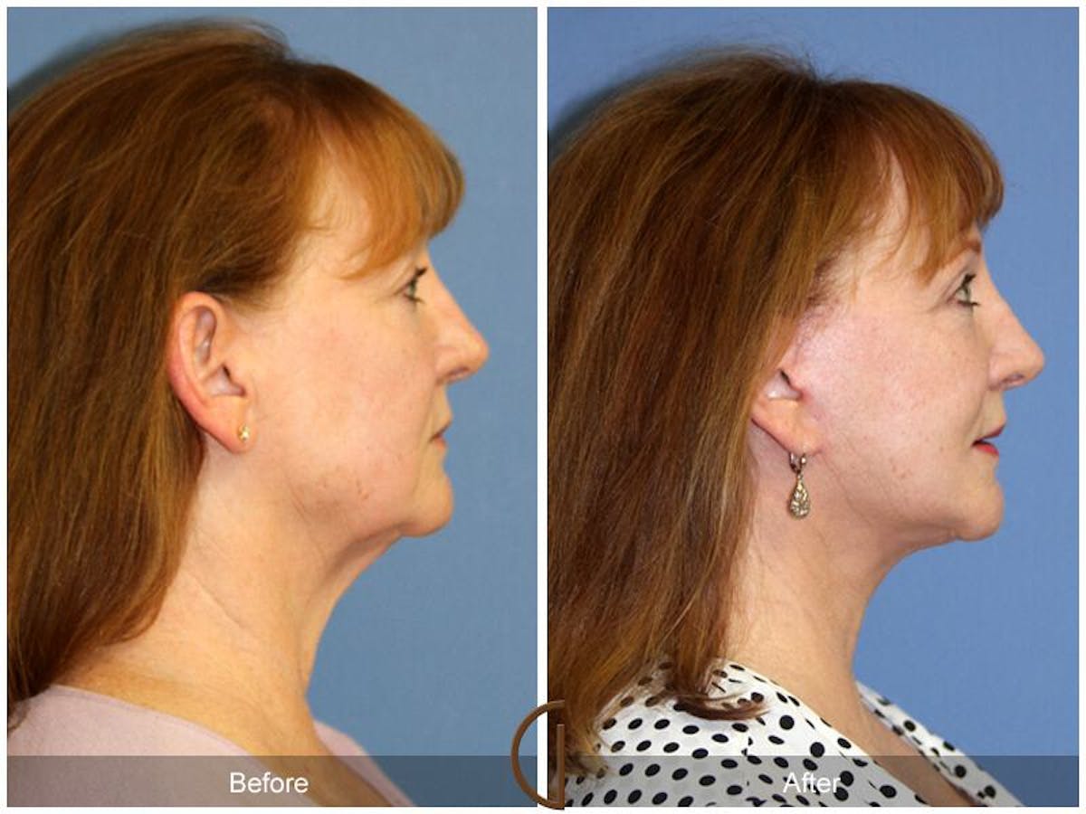 Facelift 60s Before & After Gallery - Patient 381577 - Image 3