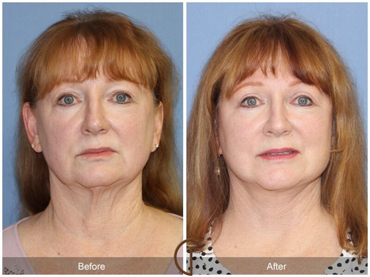 Facelift 60s Before & After Gallery - Patient 381577 - Image 2