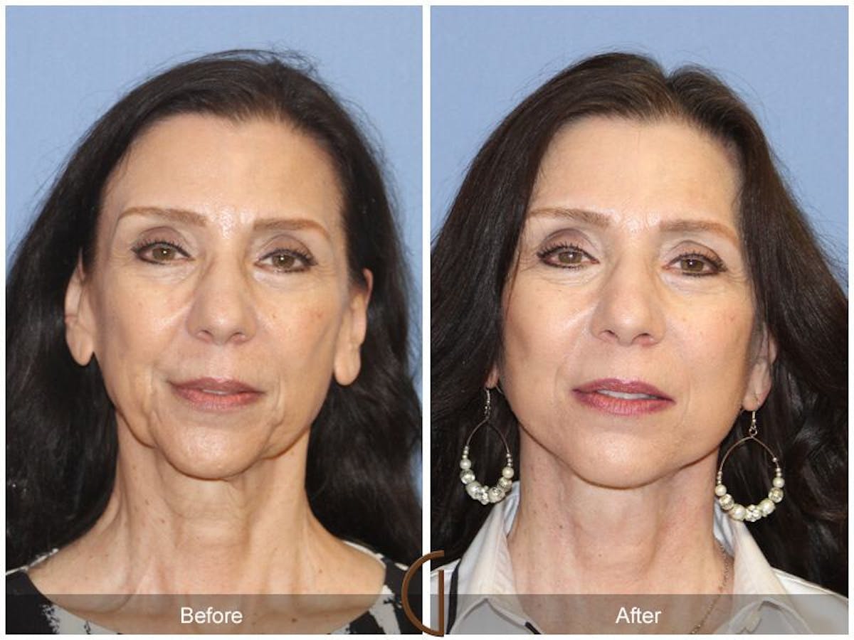 Facelift 60s Before & After Gallery - Patient 324070 - Image 2
