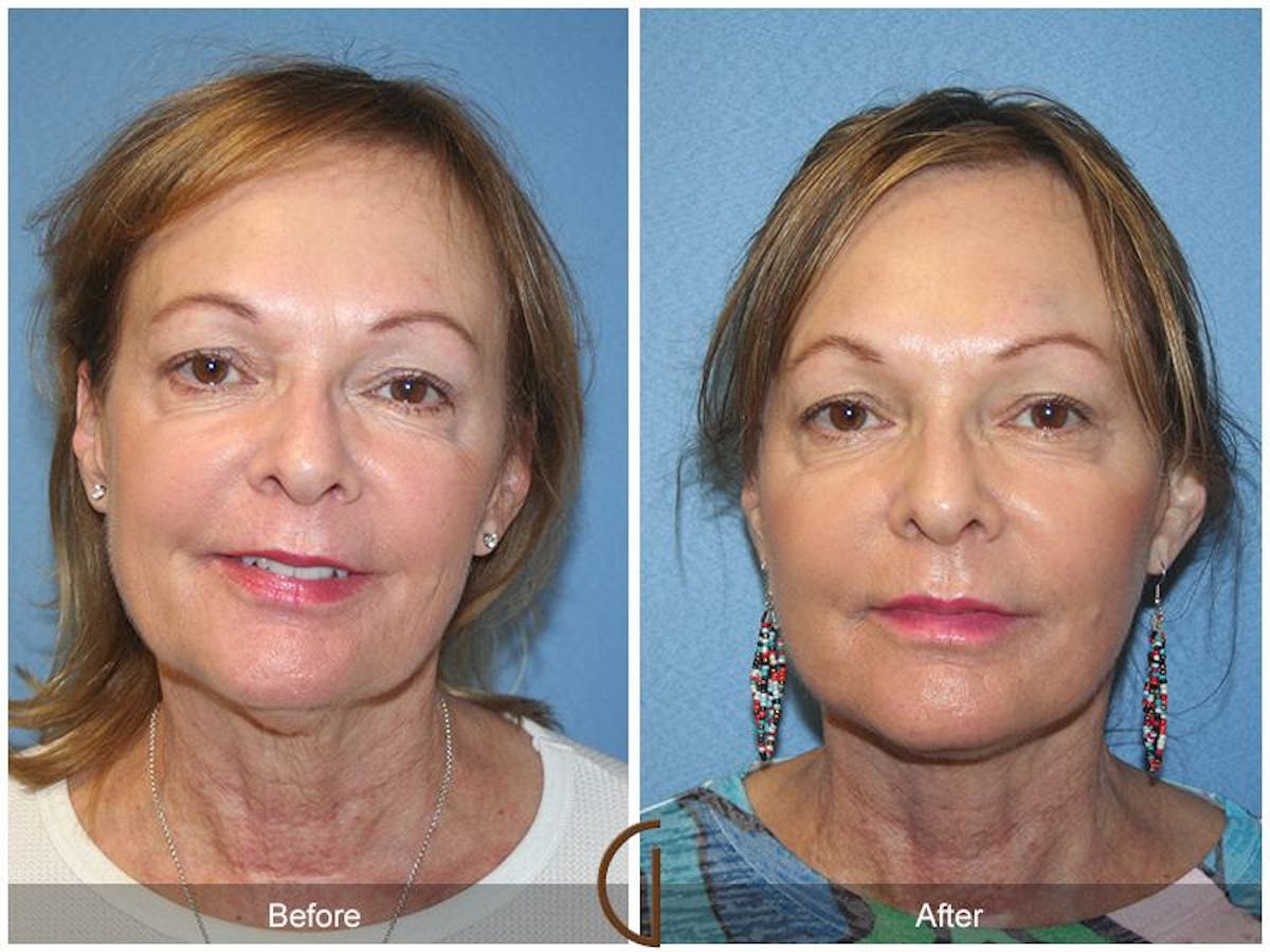 Facelift 60s Before & After Gallery - Patient 338746 - Image 2