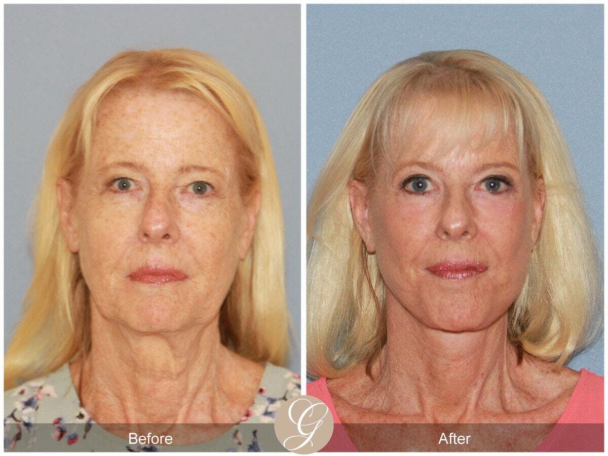 Facelift 60s Before & After Gallery - Patient 285386 - Image 2