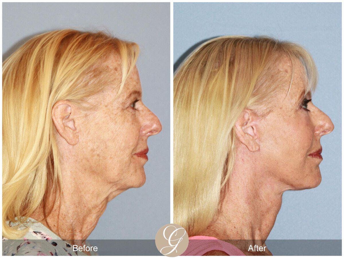 Facelift 60s Before & After Gallery - Patient 285386 - Image 3