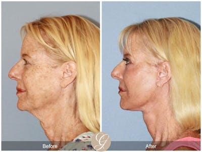 Facelift 60s Before & After Gallery - Patient 285386 - Image 1