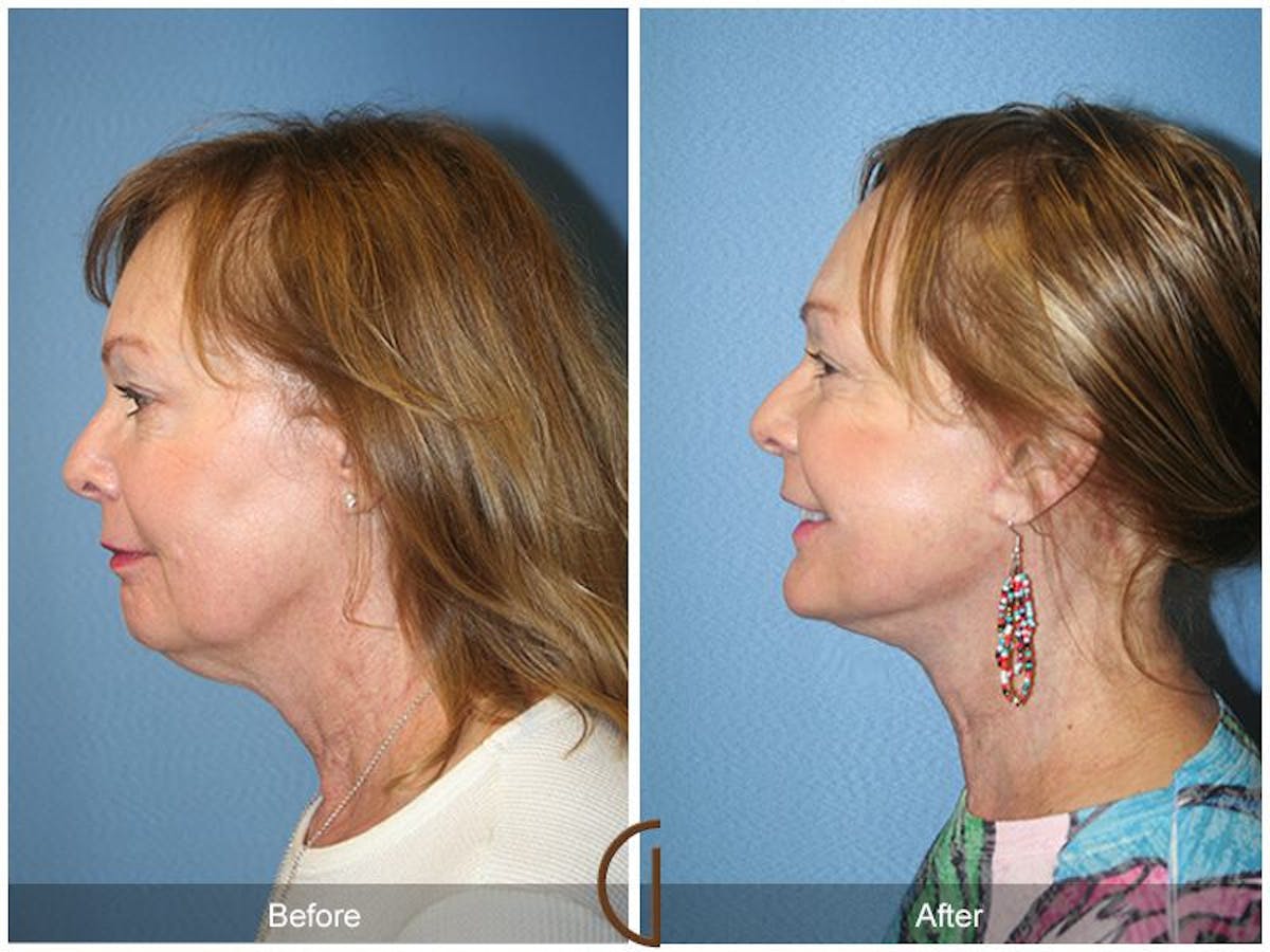 Facelift 60s Before & After Gallery - Patient 338746 - Image 1