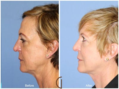 Facelift 60s Before & After Gallery - Patient 193977 - Image 1