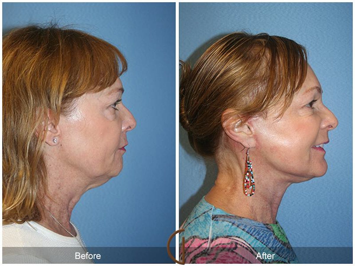 Facelift 60s Before & After Gallery - Patient 338746 - Image 3