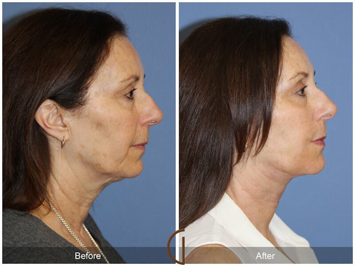 Facelift 60s Before & After Gallery - Patient 193580 - Image 3