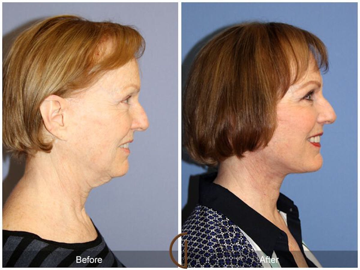 Facelift 50s Before & After Gallery - Patient 380687 - Image 3