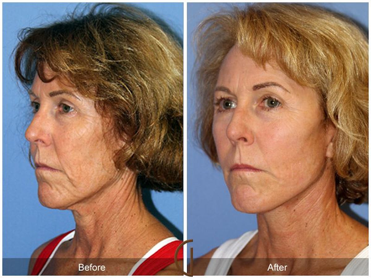 Facelift 60s Before & After Gallery - Patient 171018 - Image 1