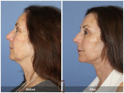 Facelift 60s Before & After Gallery - Patient 193580 - Image 1