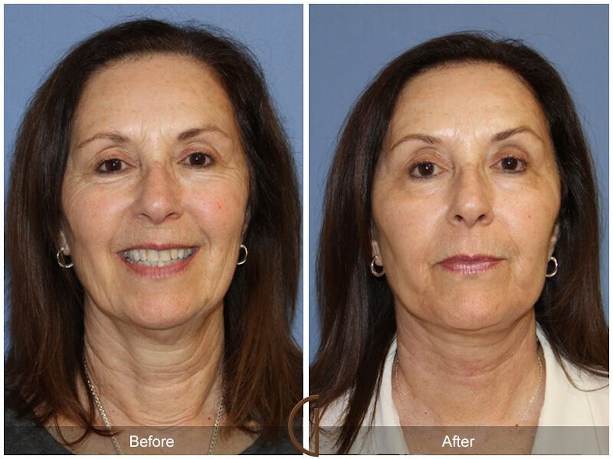 Facelift 60s Before & After Gallery - Patient 193580 - Image 2