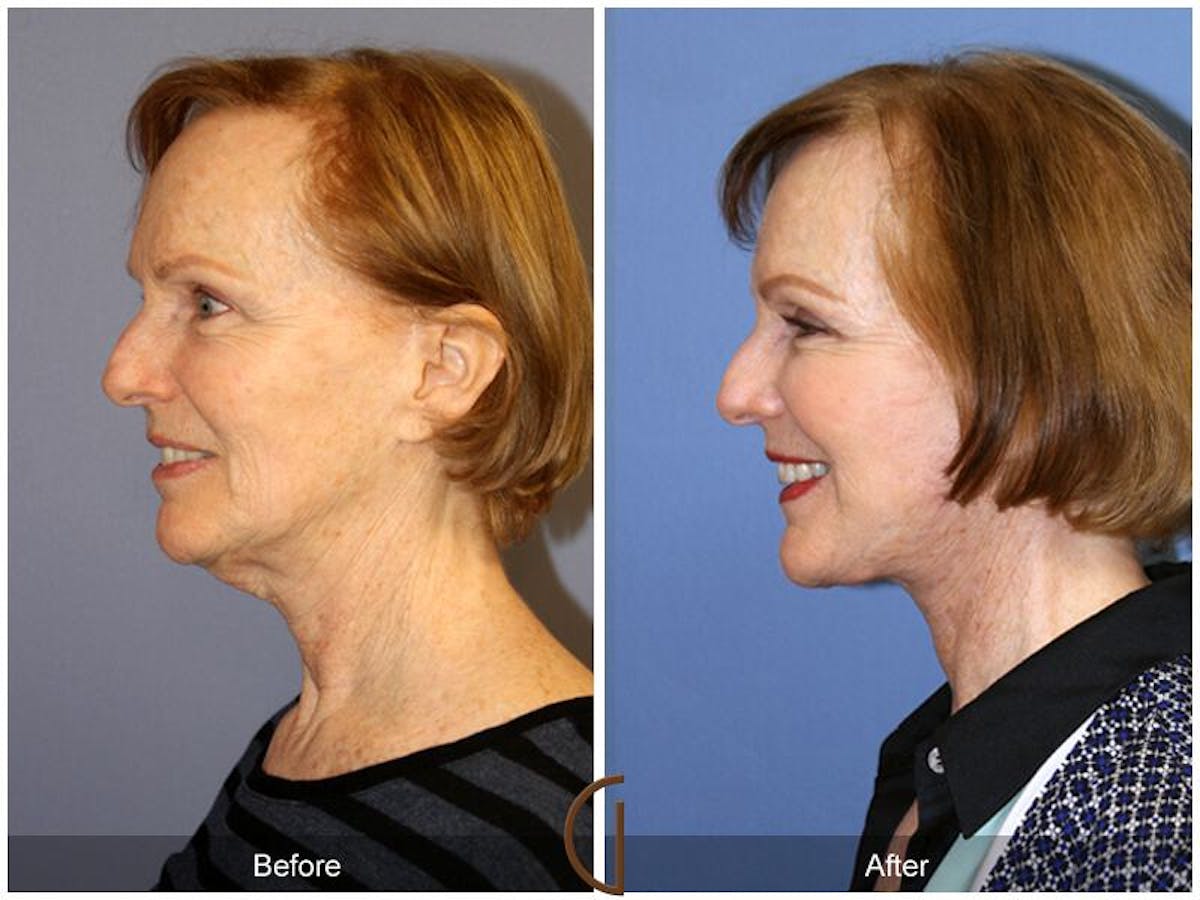 Facelift 50s Before & After Gallery - Patient 380687 - Image 1