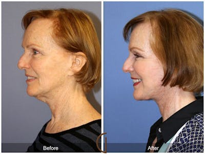 Facelift 50s Before & After Gallery - Patient 380687 - Image 1