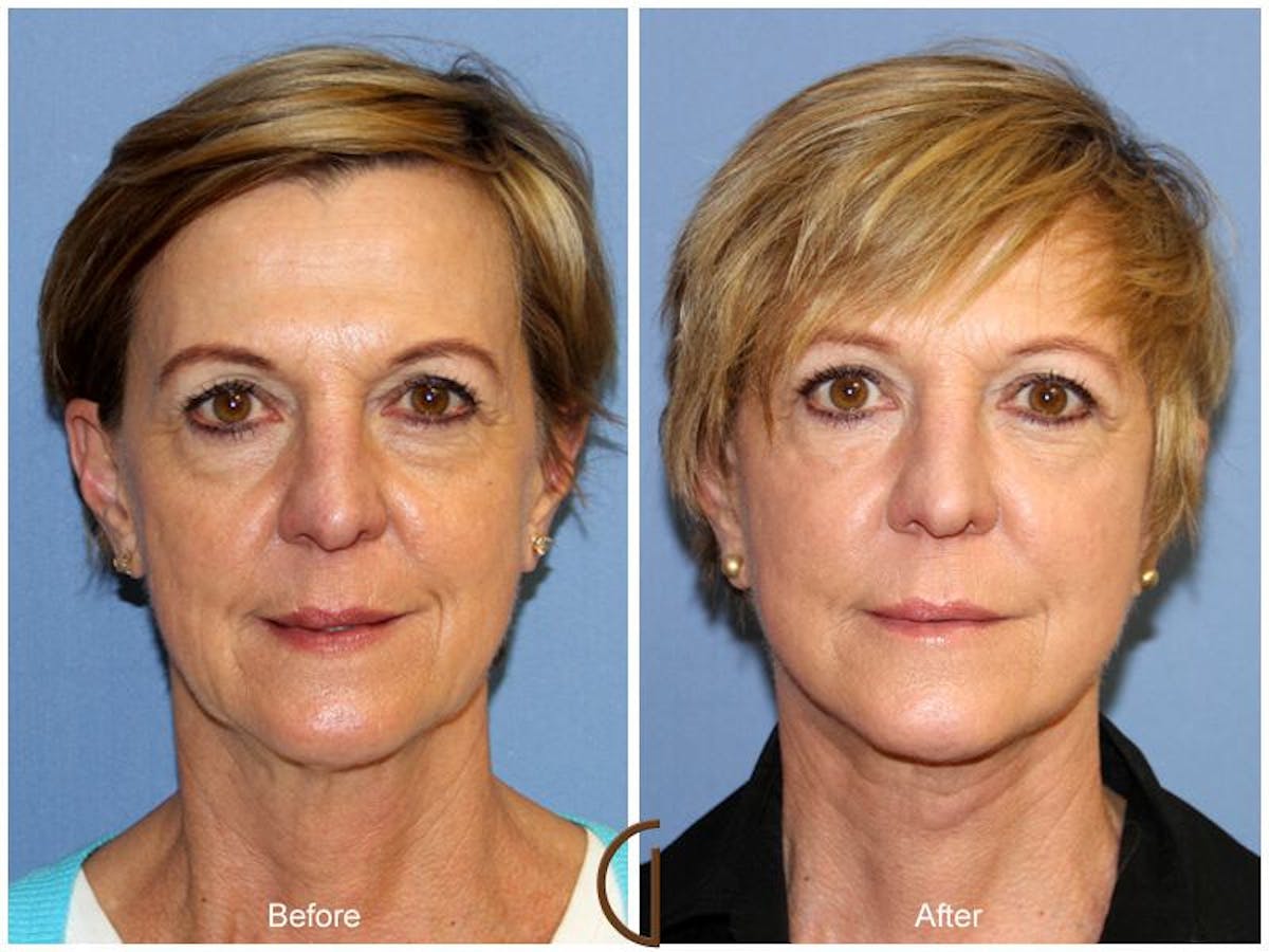 Facelift 60s Before & After Gallery - Patient 193977 - Image 2