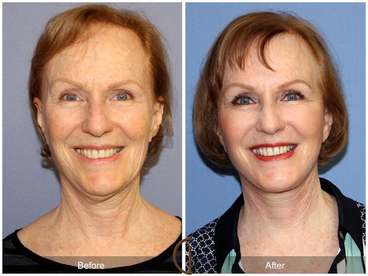 Facelift 50s Before & After Gallery - Patient 380687 - Image 2