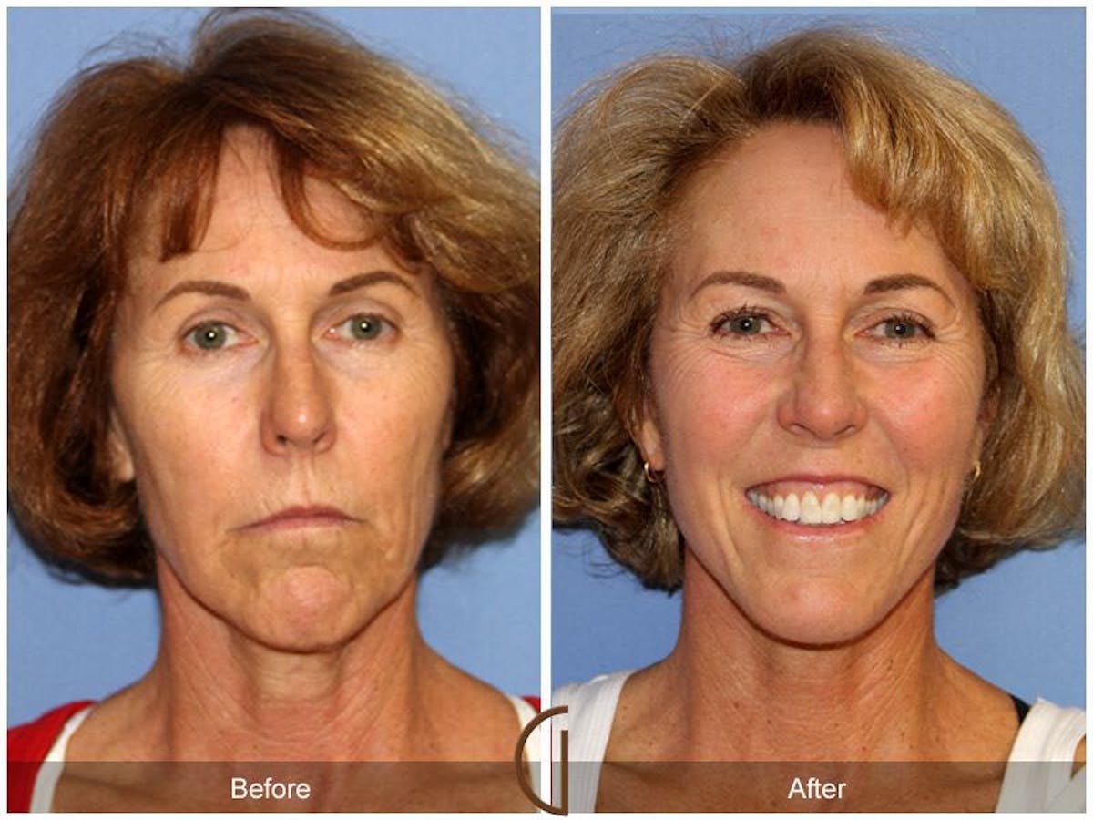 Facelift 60s Before & After Gallery - Patient 171018 - Image 2